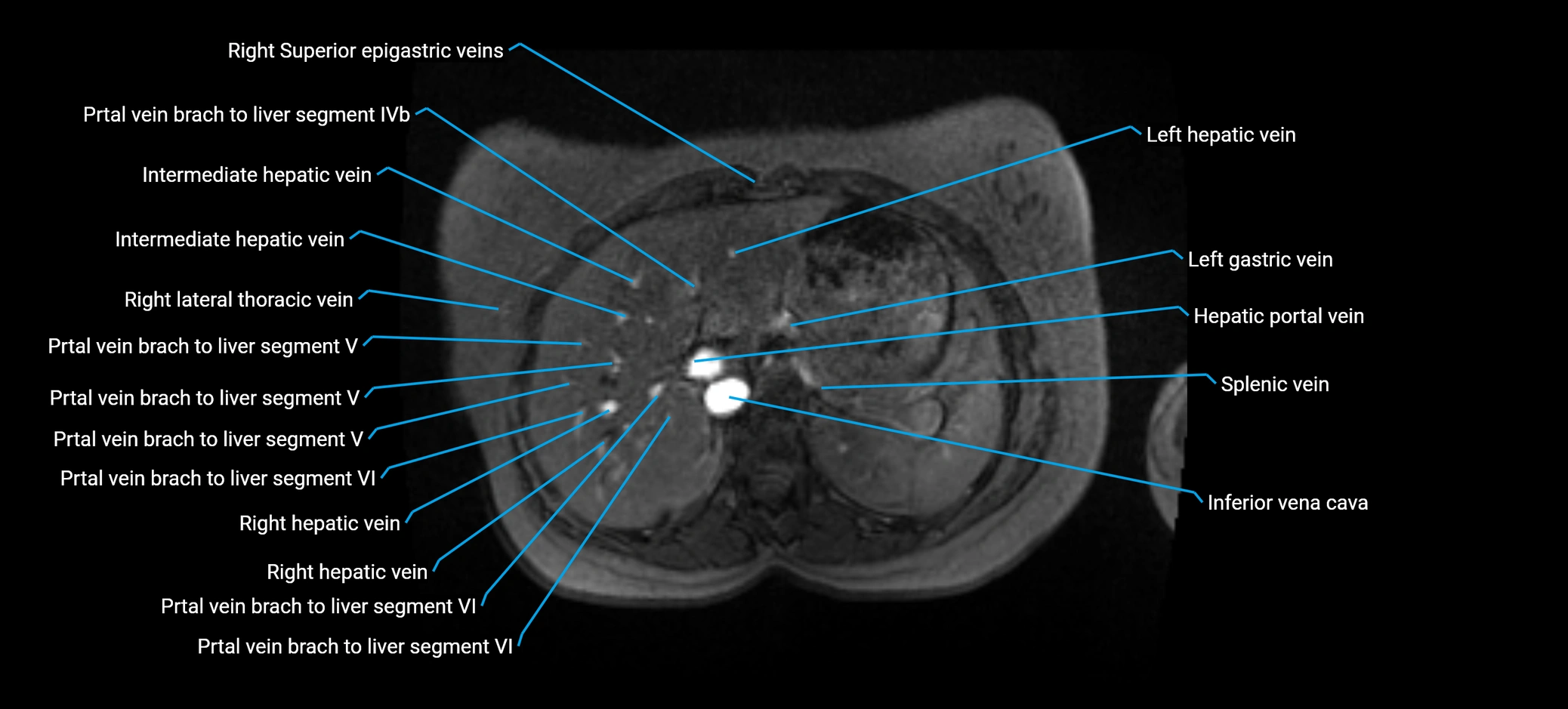 MRV abdomen pelvis & lower limb axial cross sectional anatomy labelled MRI image 43 (1).webp